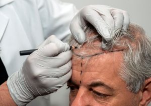 A medical professional in gloves marks a hairline on the scalp of a patient during a hair transplant procedure. The image highlights the precision involved in the preparation phase, showcasing the importance of careful planning in cosmetic surgery. The patient appears calm as the practitioner uses a fine pen to outline the intended hairline, illustrating the meticulous nature of hair restoration techniques. This visual representation emphasizes the advancements in hair transplant methods and the attention to detail required for successful outcomes.